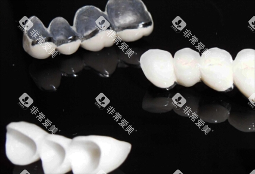 不同种类烤瓷牙模型展示