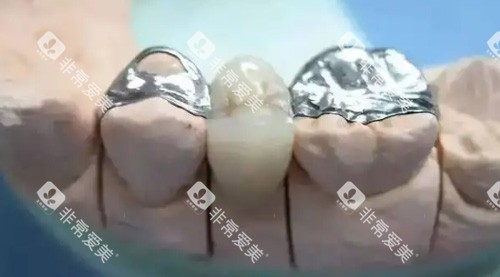 镶牙治疗细节图