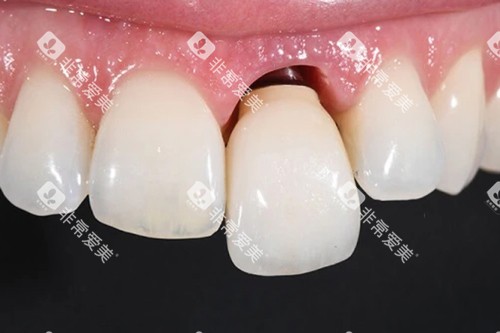 种植牙牙冠松动模型图