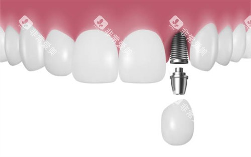 前牙区种植牙示意图