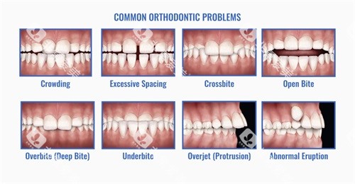 各种牙齿错合畸形问题