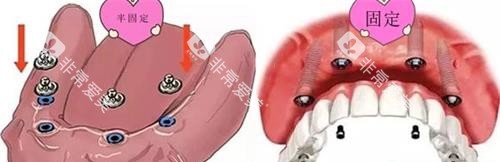 半口半固定种植牙