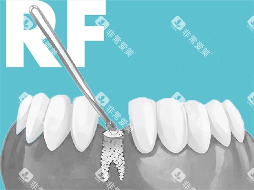 种植牙植骨漫画图