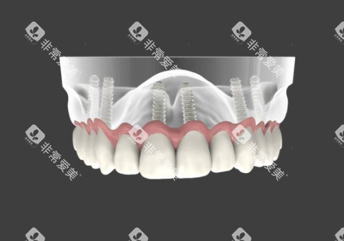 半口种植牙模型图