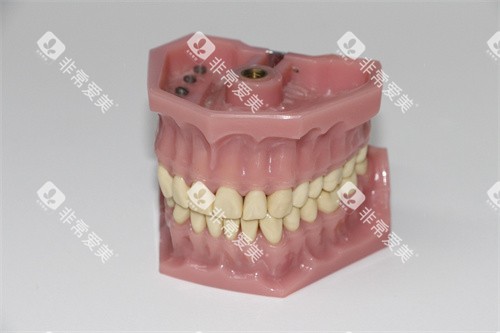 牙齿模型示意图