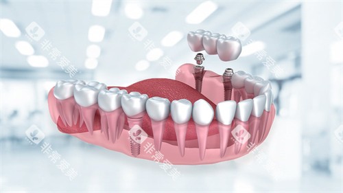 种植牙动画展示图 种植牙动画展示图