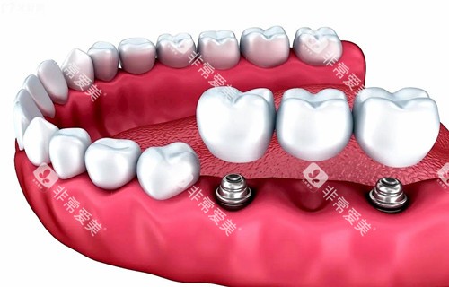 多颗种植牙种植模型示意图 多颗种植牙种植模型示意图