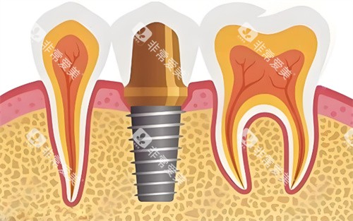 种植牙展示图片展示图 种植牙展示图片展示图