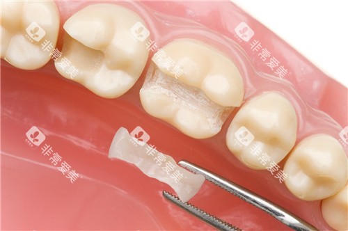 补牙嵌体模型示意图