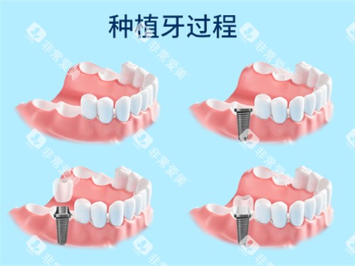 种植牙过程漫画示意图 种植牙过程漫画示意图