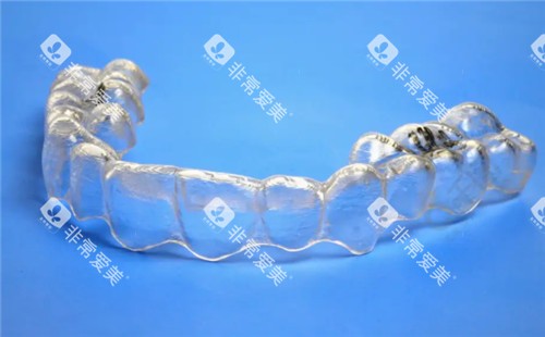 隐形牙套单幅照片 隐形牙套单幅照片