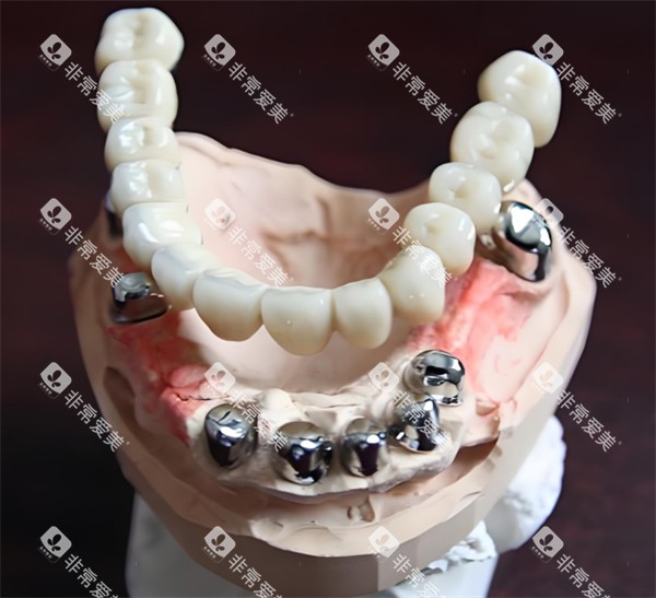 套筒冠模型示意图