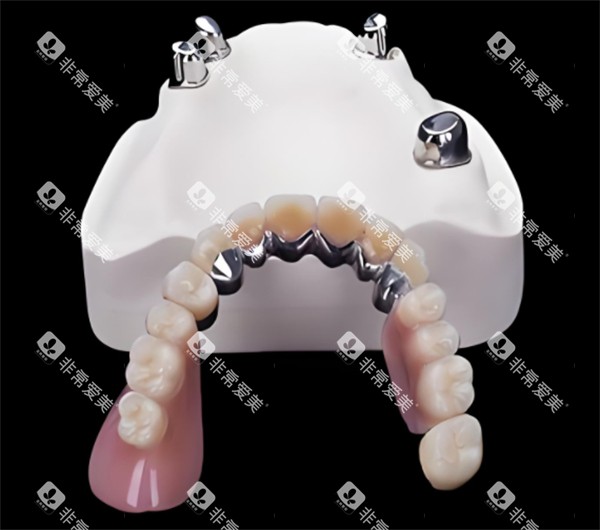 套筒冠模型展示图