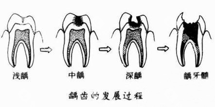 龋齿的发展过程示意图