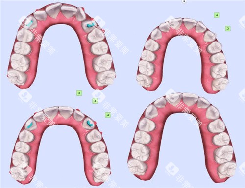 牙齿矫正模拟结果对比 牙齿矫正模拟结果对比