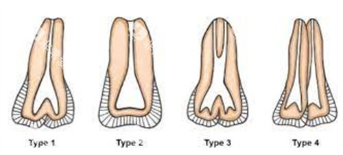 正常牙齿和双生牙