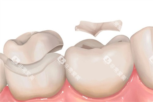 高位嵌体和一般嵌体对比