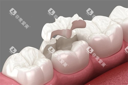 高位嵌体卡通图