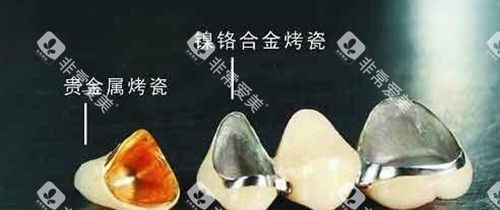 烤瓷牙不同材料示意图