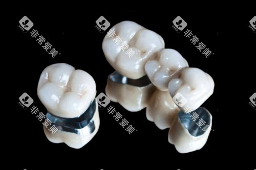 烤瓷牙冠模型图