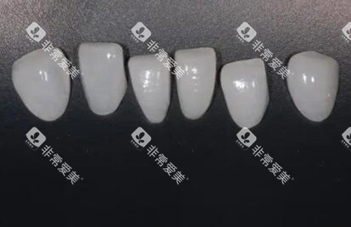 牙齿贴面修复改善