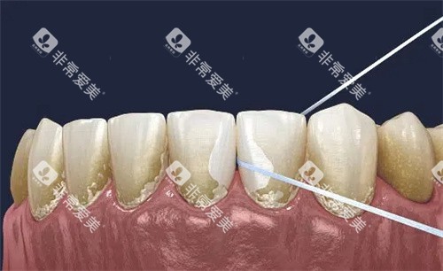 牙线清理牙齿缝隙