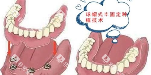 漫画半口种植牙示意图 漫画半口种植牙示意图