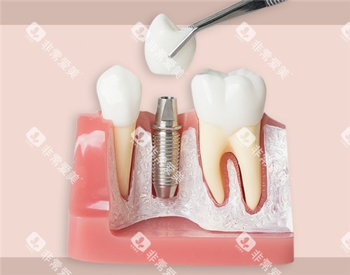 种植牙模具图片 种植牙模具图片