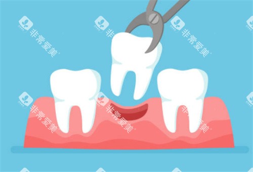 牙齿拔牙示意图