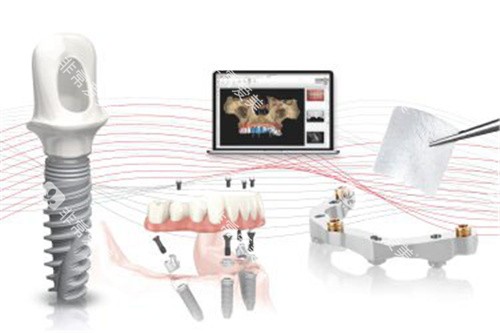 诺贝尔种植牙02 诺贝尔种植牙02