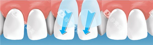 门牙贴面过程