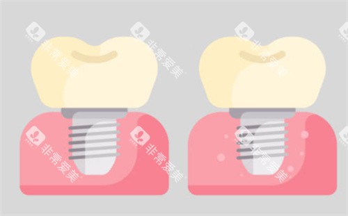 种植牙对比图 种植牙对比图
