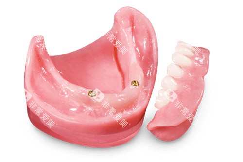 locator半固定种植牙种植修复体 locator半固定种植牙种植修复体