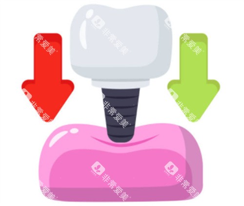 种植牙的用力示意图 种植牙的用力示意图