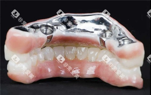 钛合金全口义齿