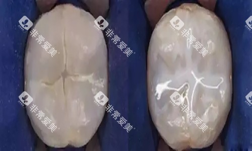 牙齿窝沟封闭卡通示意图