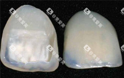牙齿贴面成品 牙齿贴面成品