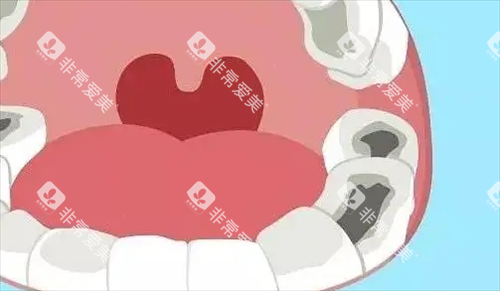 口腔牙齿龋齿动画展示情况