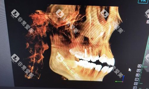 金华东阳马爽口腔牙齿拍片示意图