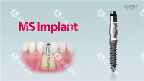奥齿泰种植牙 奥齿泰种植牙