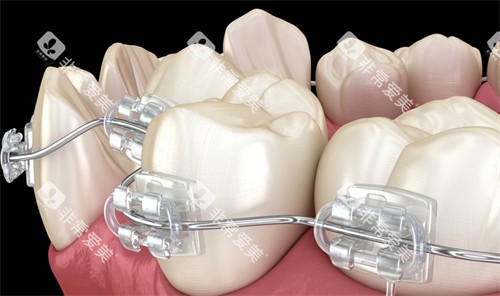 半隐形托槽牙齿矫正细节图