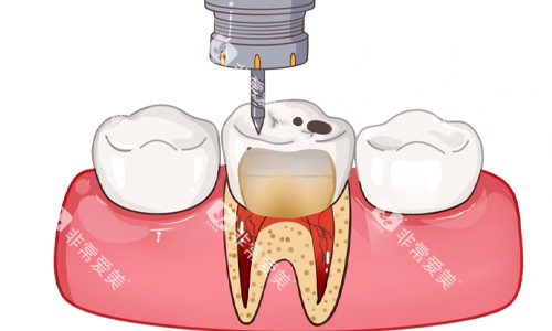清除牙齿龋坏部分展示 清除牙齿龋坏部分展示