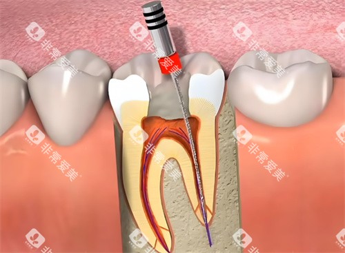 根管治疗动画展示 根管治疗动画展示