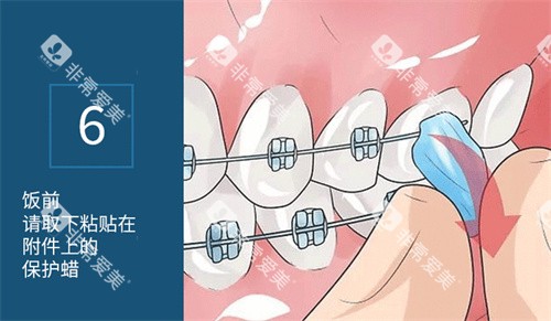 正畸保护蜡使用方法展示图 正畸保护蜡使用方法展示图