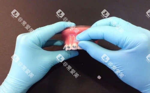 正畸保护蜡使用示意图 正畸保护蜡使用示意图