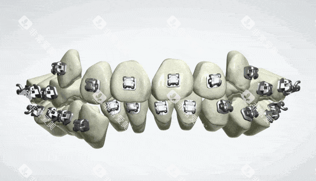 奥世美<span class='highlight'>数字化</span>正畸定位模型示意图 奥世美<span class='highlight'>数字化</span>正畸定位模型示意图