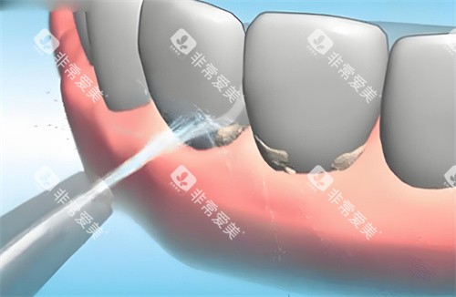 洗牙动画展示图片 洗牙动画展示图片
