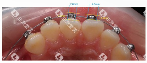 牙齿矫正OBrace球面托槽对比方形托槽大小