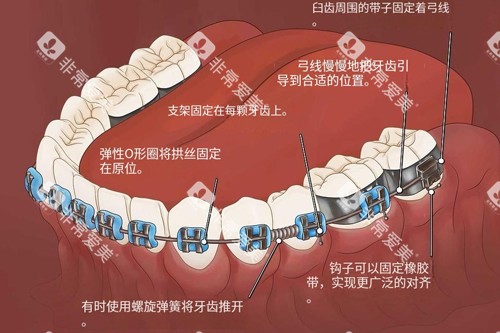 金属牙齿矫正器功能示意图