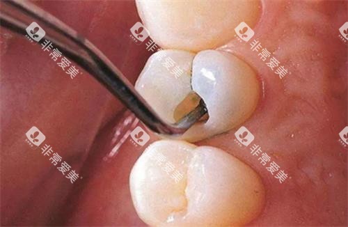 补牙的示意图